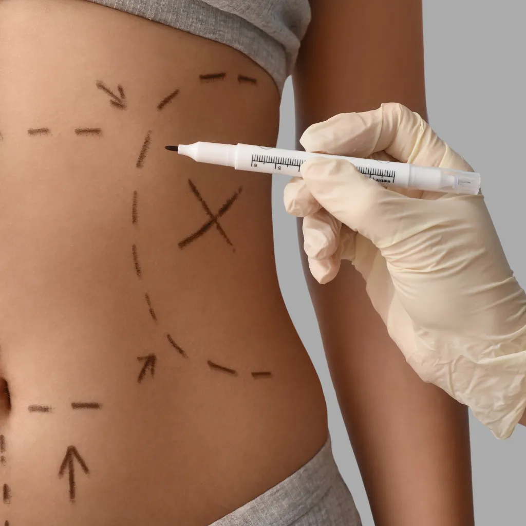 Abdominoplastia