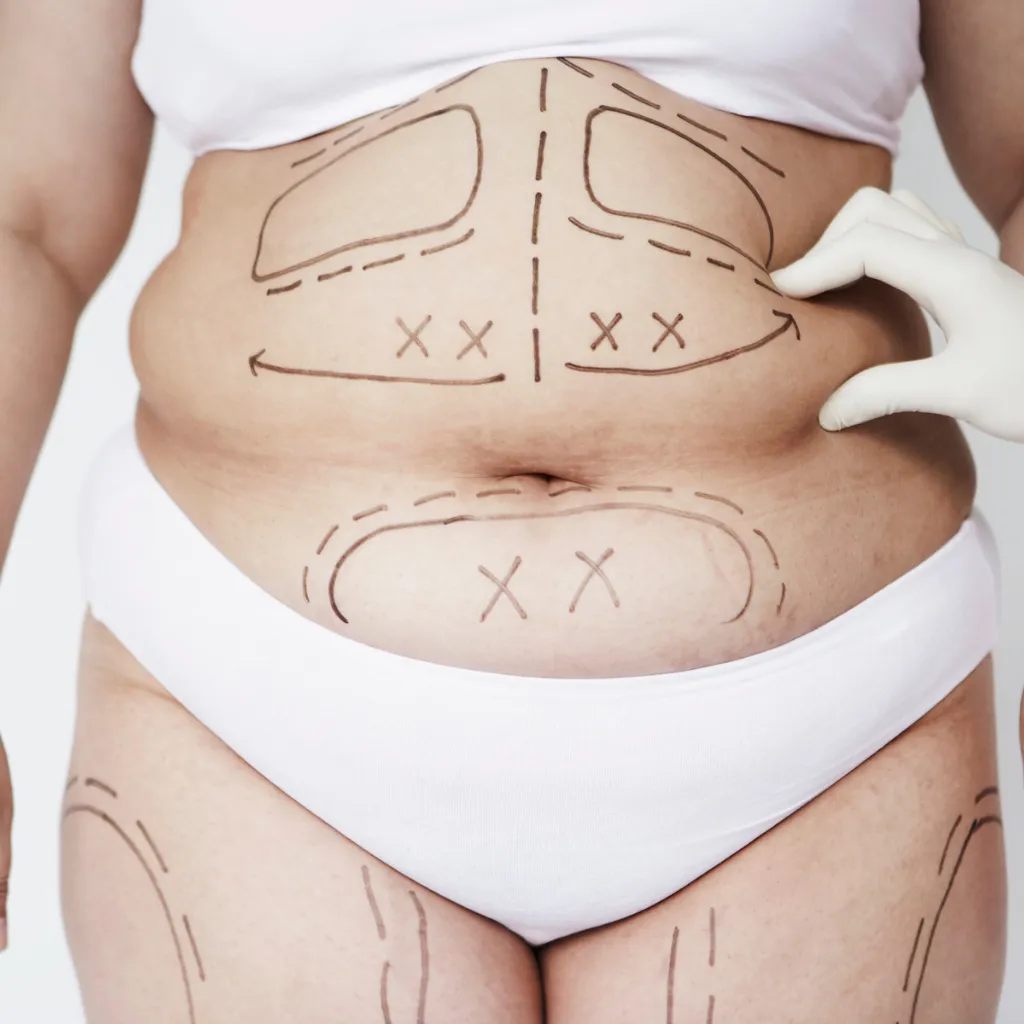 Lipoaspiração