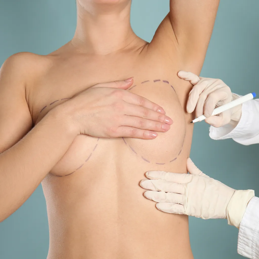 Mamoplastia de Aumento