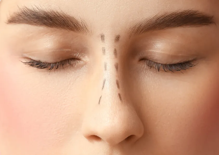 Rinoplastia estruturada