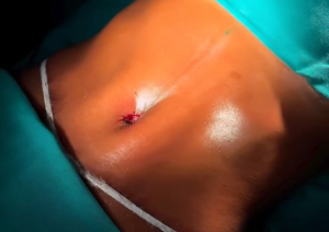 Como é feito a Abdominoplastia