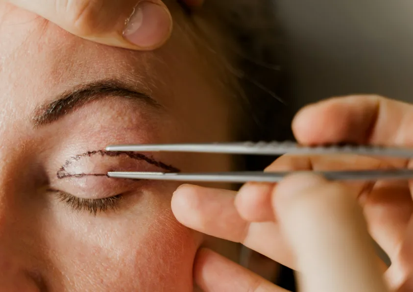 blefaroplastia