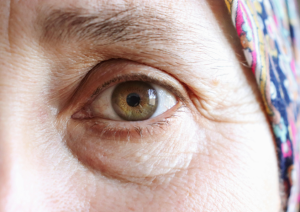 blefaroplastia