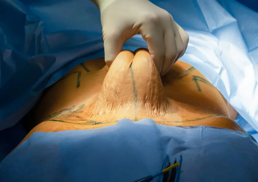 Cirurgia Reparadora Pós-Bariátrica