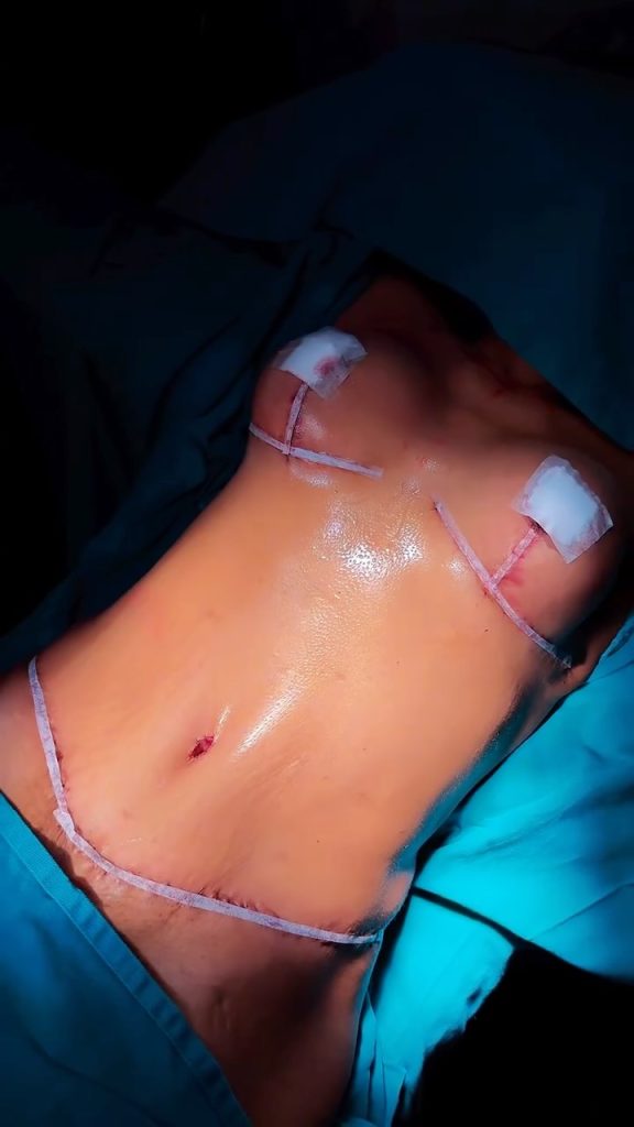 Vale a pena fazer mais de uma cirurgia ao mesmo tempo
